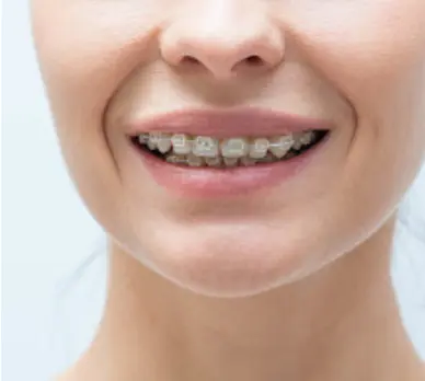 Five Benefits of Invisible Clear Aligners Over Metal Braces